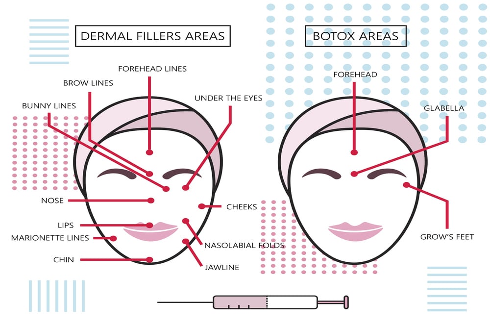 Diagram of dermal filler treatment areas in the face
